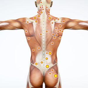Trigger point therapy